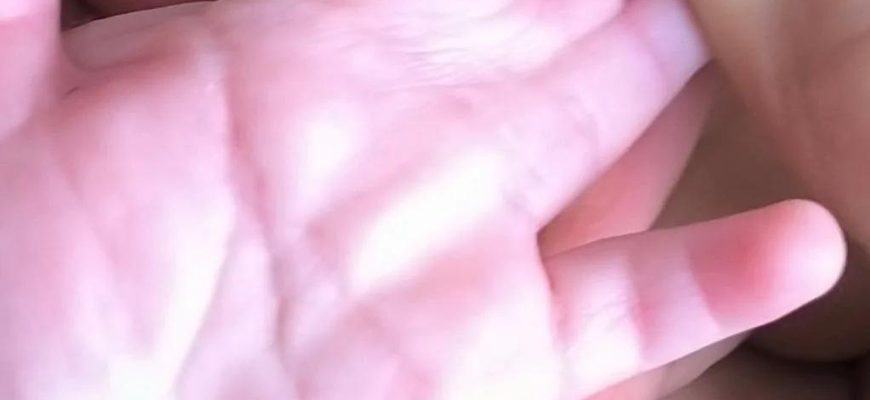 В Клиниках СамГМУ ребенку со сращением пальцев вернули полноценную работу кисти В Клиниках СамГМУ ребенку со сращением пальцев вернули полноценную работу кисти